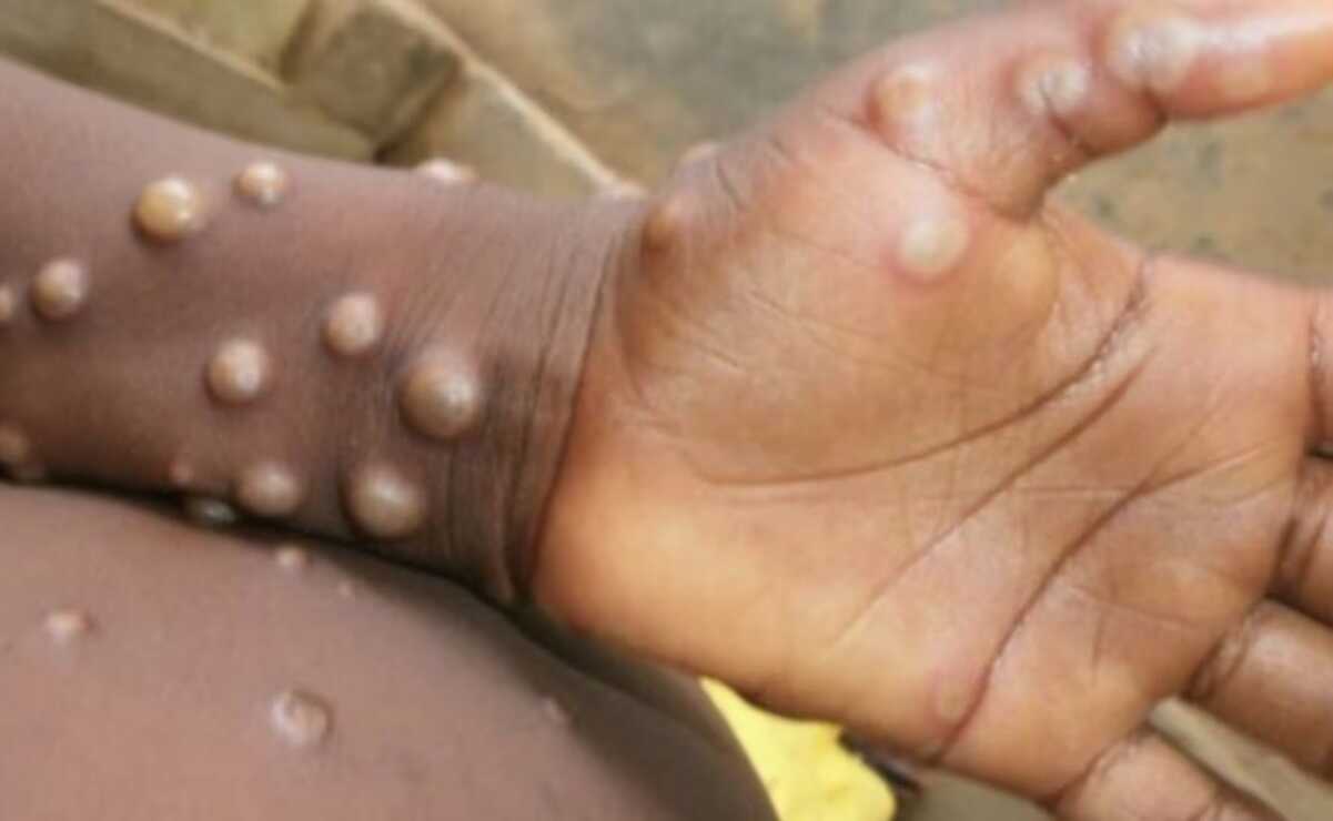 Levanta OMS la emergencia internacional por la viruela del mono 