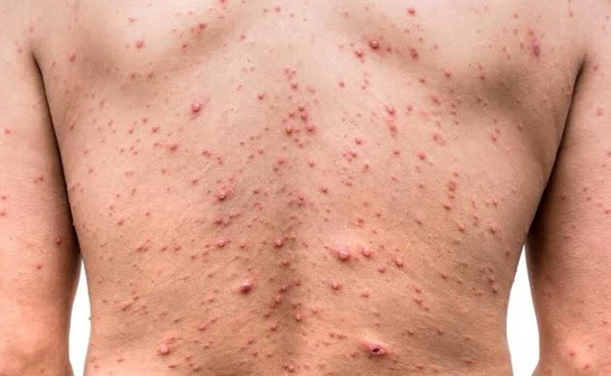 Confirman segundo caso de viruela del mono en San Luis Potosí. Foto: Archivo EL UNIVERSAL