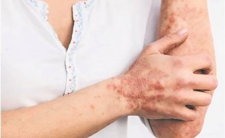 ¿Cuáles son los síntomas y cómo se da la transmisión de la viruela del mono?