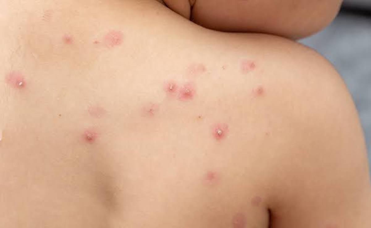 ¿Caso de viruela símica en Ciudad Valles? Esto es lo que sabemos