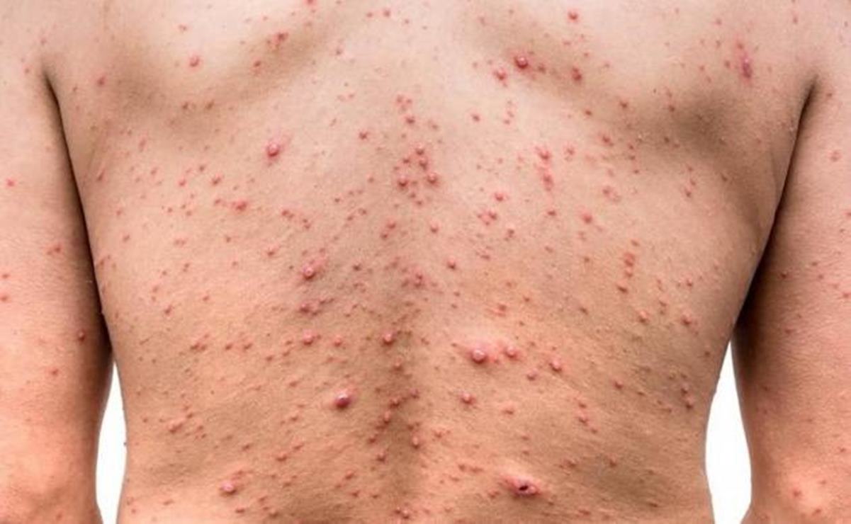 San Luis Potosí registró 12 casos de viruela símica en el último año