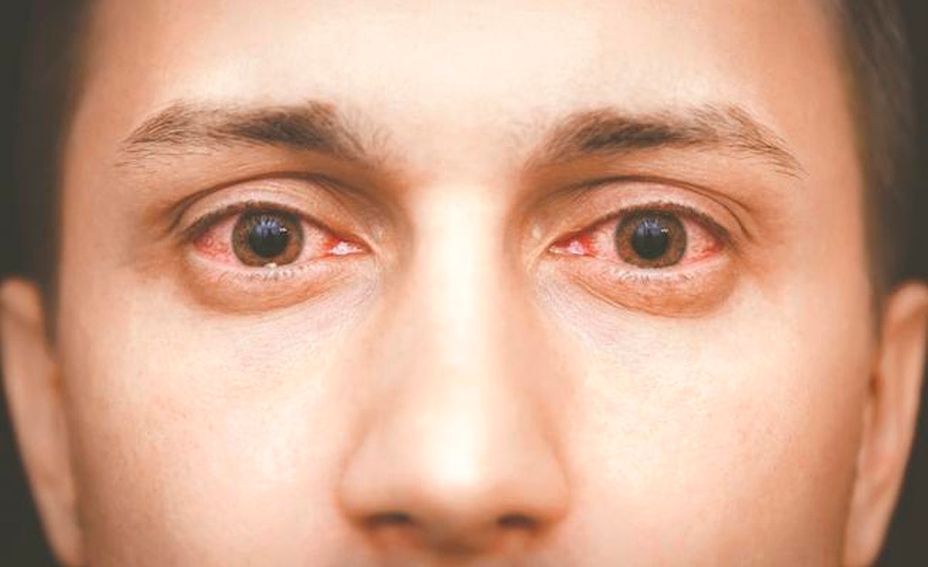 Síndrome de Sjögren: uno de los principales trastornos autoinmunes