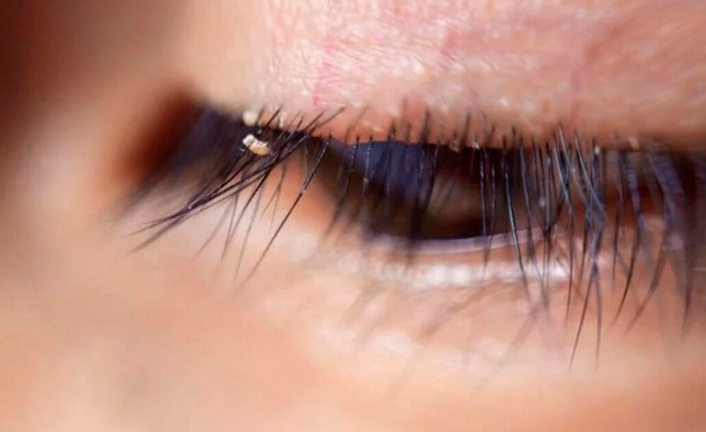 ¿Piojos en las pestañas? Sí, esto sucede y va en aumento