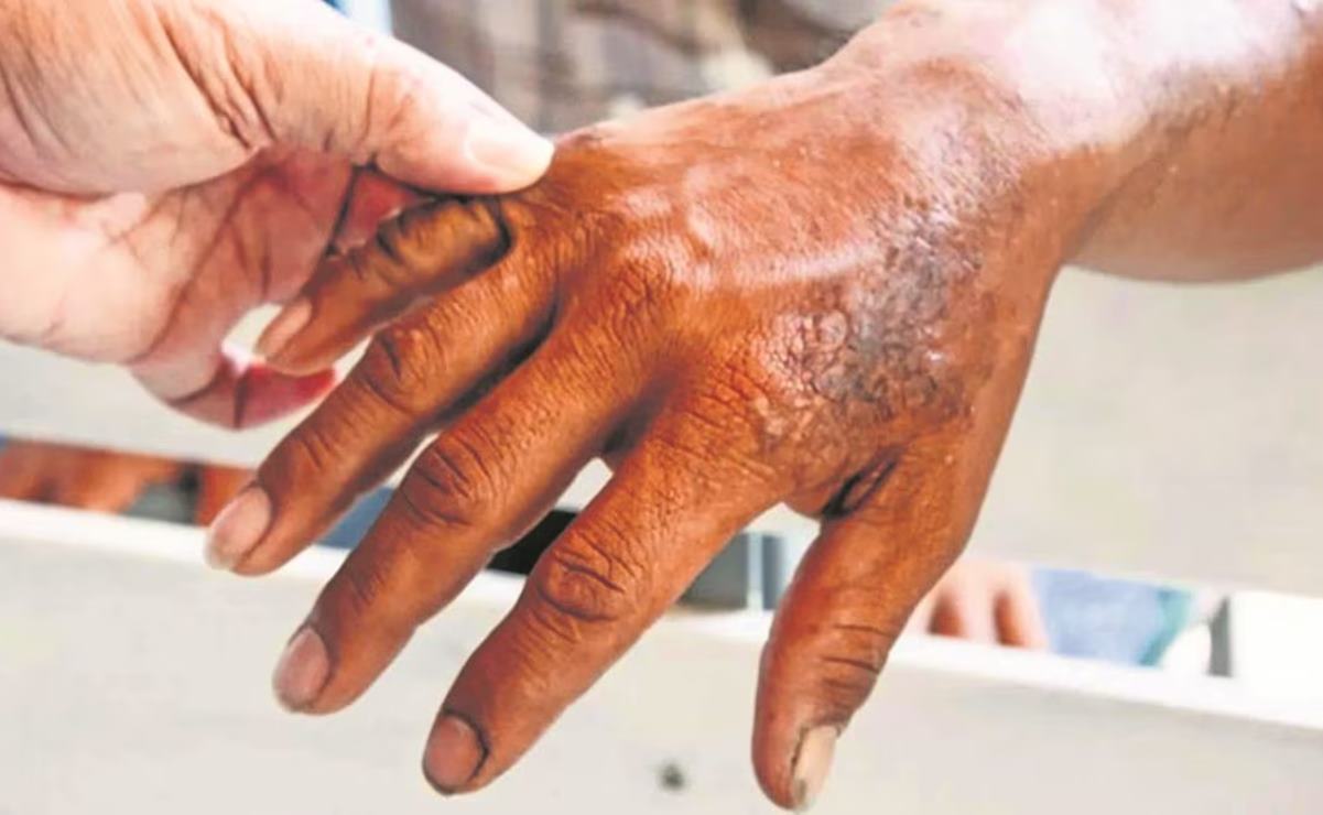 Registra San Luis Potosí tres casos de lepra en lo que va del 2023