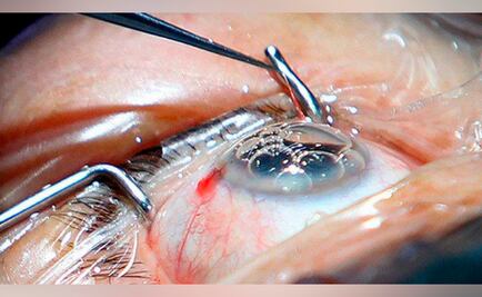 IMSS desarrollará 150 cirugías de cataratas