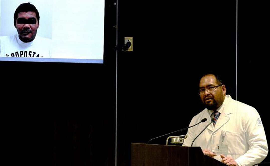 Carlos Eduardo Ordoñez Morales, coordinador de la Unidad Médico Quirúrgica del Hospital Juárez del Centro, explica el procedimiento realizado para extirpar, reconstruir y rehabilitar al paciente. Foto: Especial