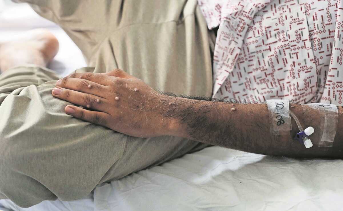 OMS declara emergencia internacional de salud por mpox, antes viruela del mono