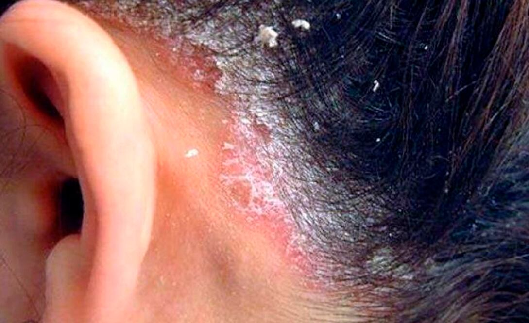 La enfermedad que se confunde con caspa