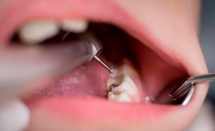 Las caries pueden causar complicaciones que llevan a la muerte