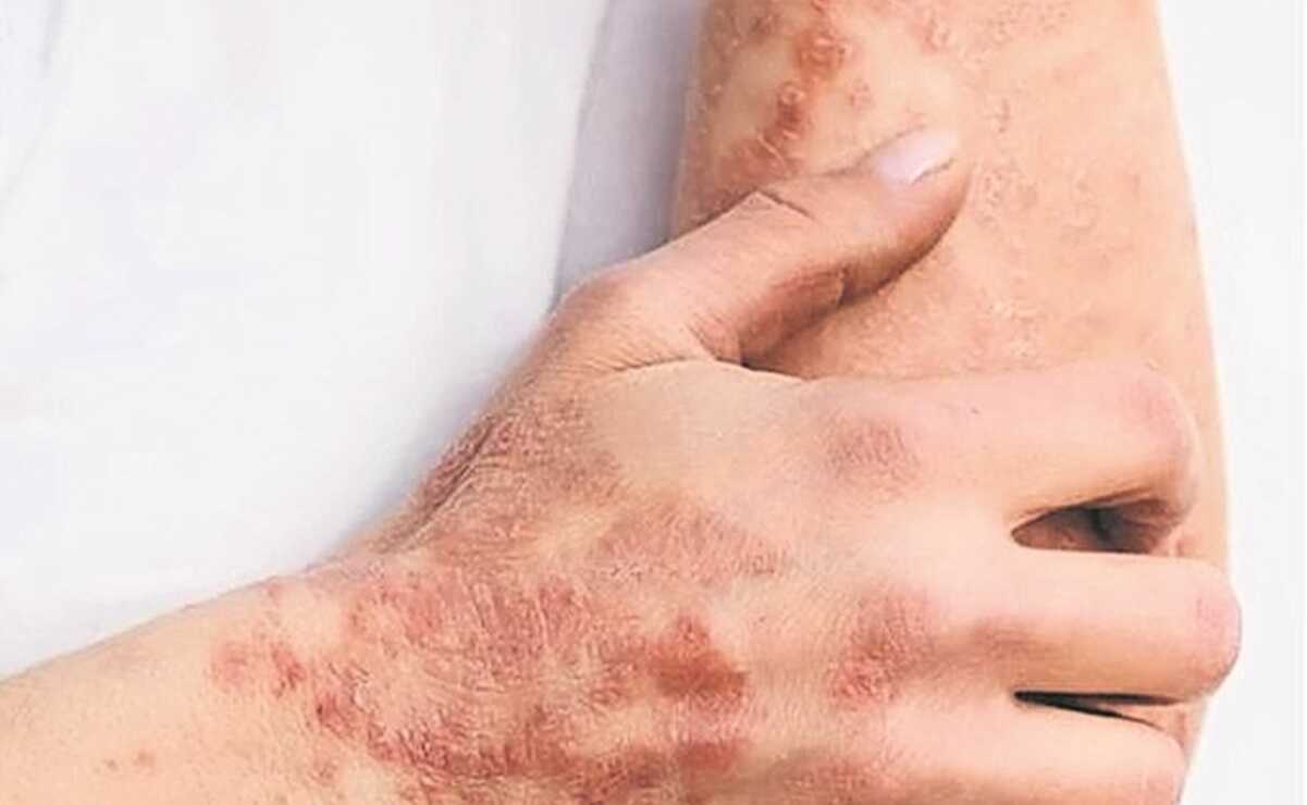 Dan de alta a paciente potosino con viruela del mono