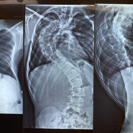 Realizan cirugía histórica en San Luis Potosí  