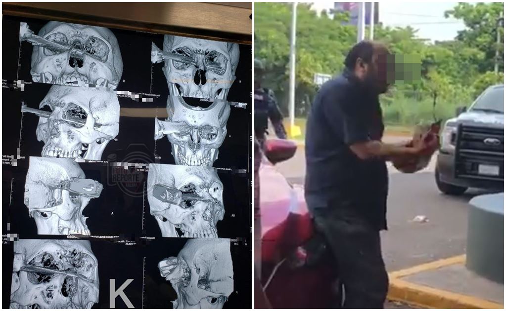 Hombre acuchillado por pelear cajón de estacionamiento pierde el ojo