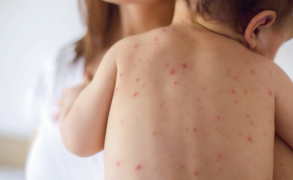 Salud prevé 2 o 3 decenas de casos importados de sarampión en 2019