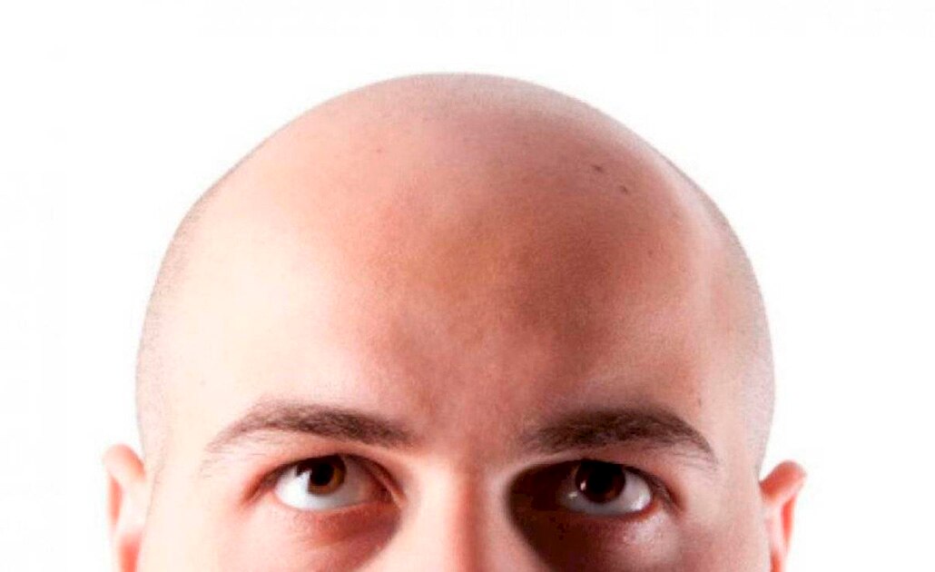La calvicie no tiene cura y afecta a 50% de los jóvenes mexicanos