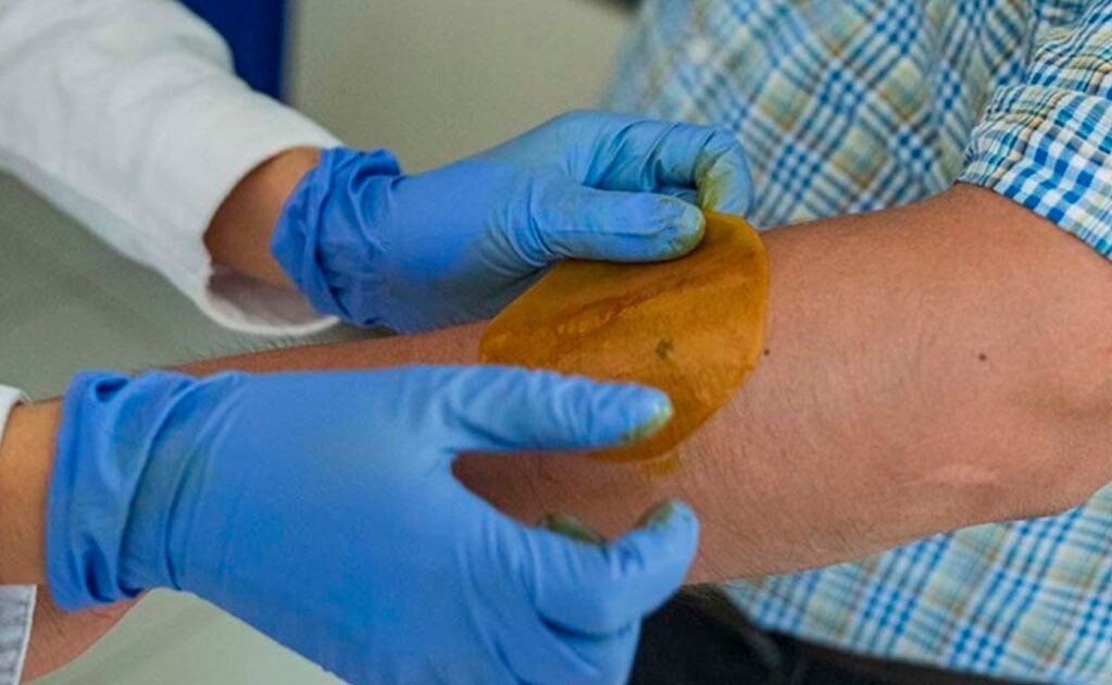 Desarrollan en la UNAM parche para regenerar la piel de diabéticos