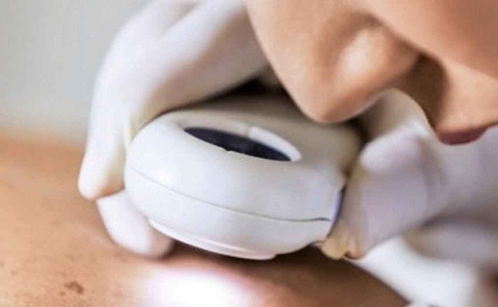 Disminuye presencia de lepra en México; en 2018, sólo 388 casos