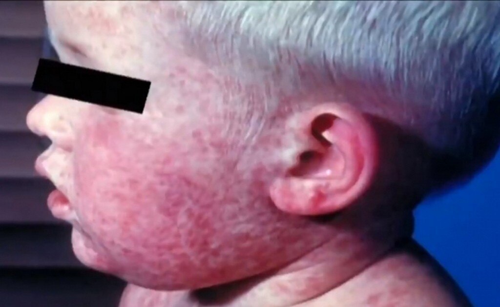 El niño que revivió el brote de sarampión en Estados Unidos