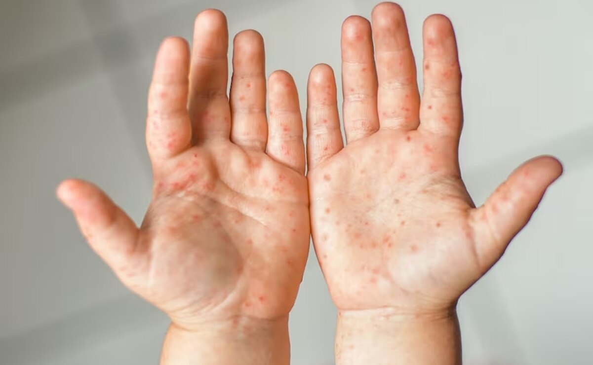 Virus de Coaxsackie: ¿Qué lo provoca y cómo identificarlo?