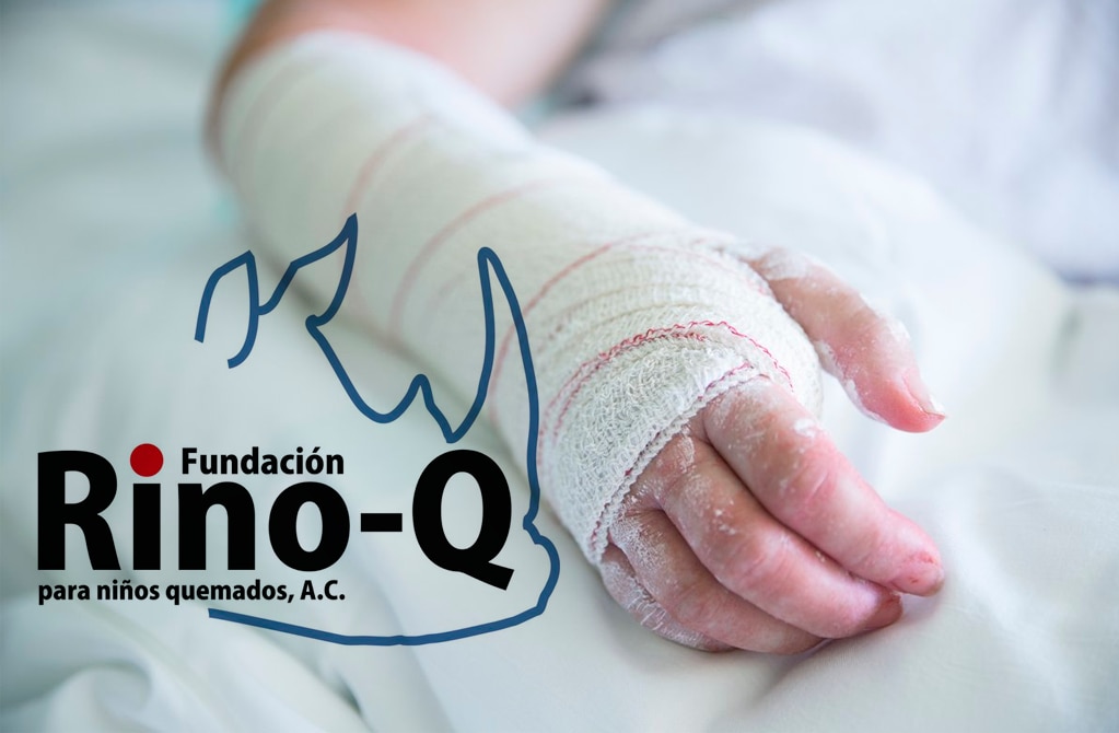 Al menos 400 niños quemados, atendidos por Fundación Rino Q