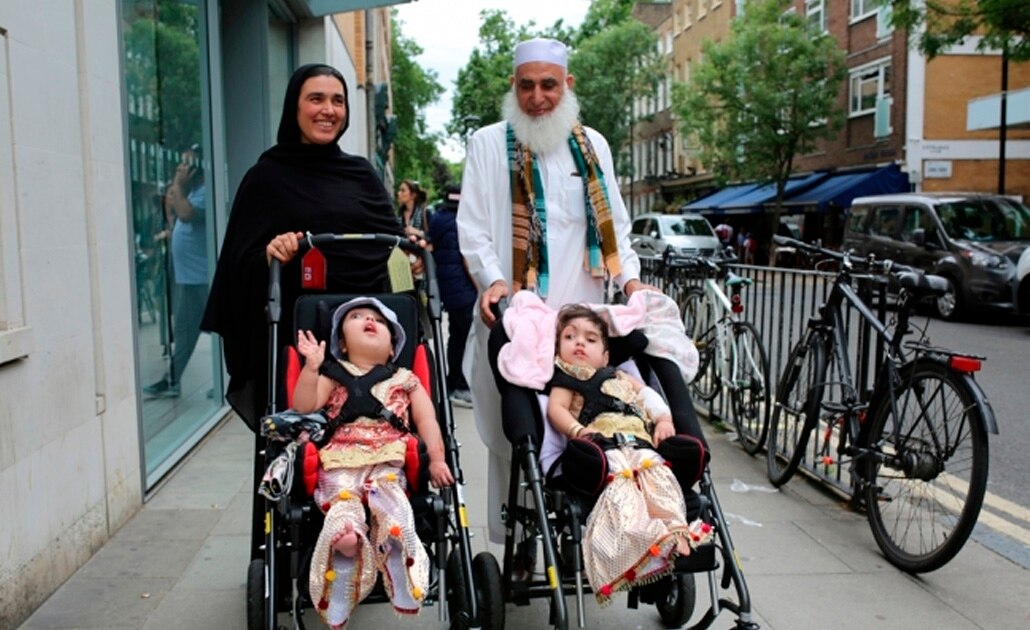 Logran separar a gemelas unidas por el cráneo