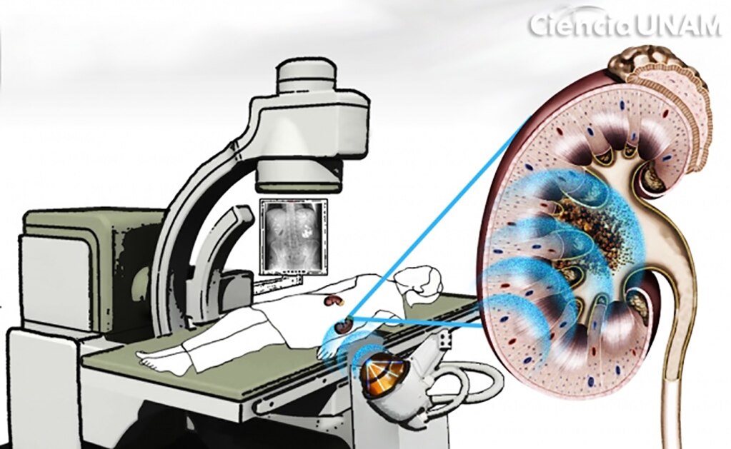 Utilizan universitarios ondas de choque en aplicaciones biomédicas