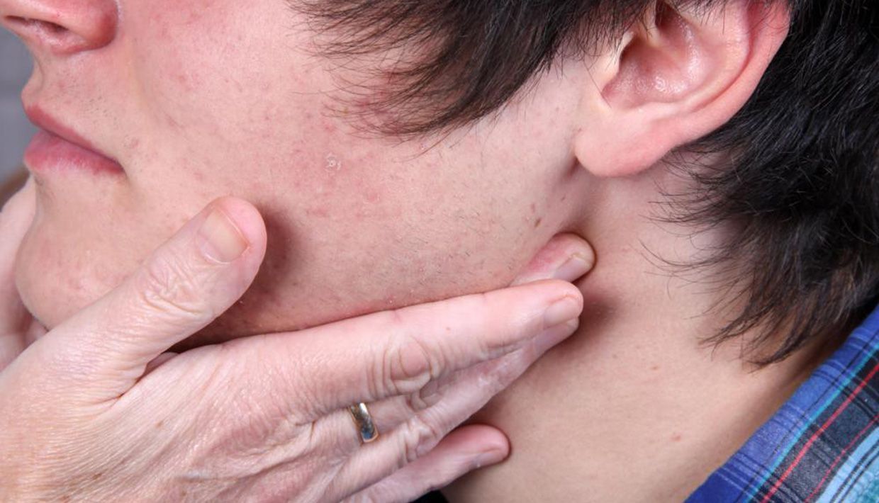 SLP sin riesgo eminente por contagio de paperas