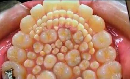 La enfermedad que llena la boca de dientes