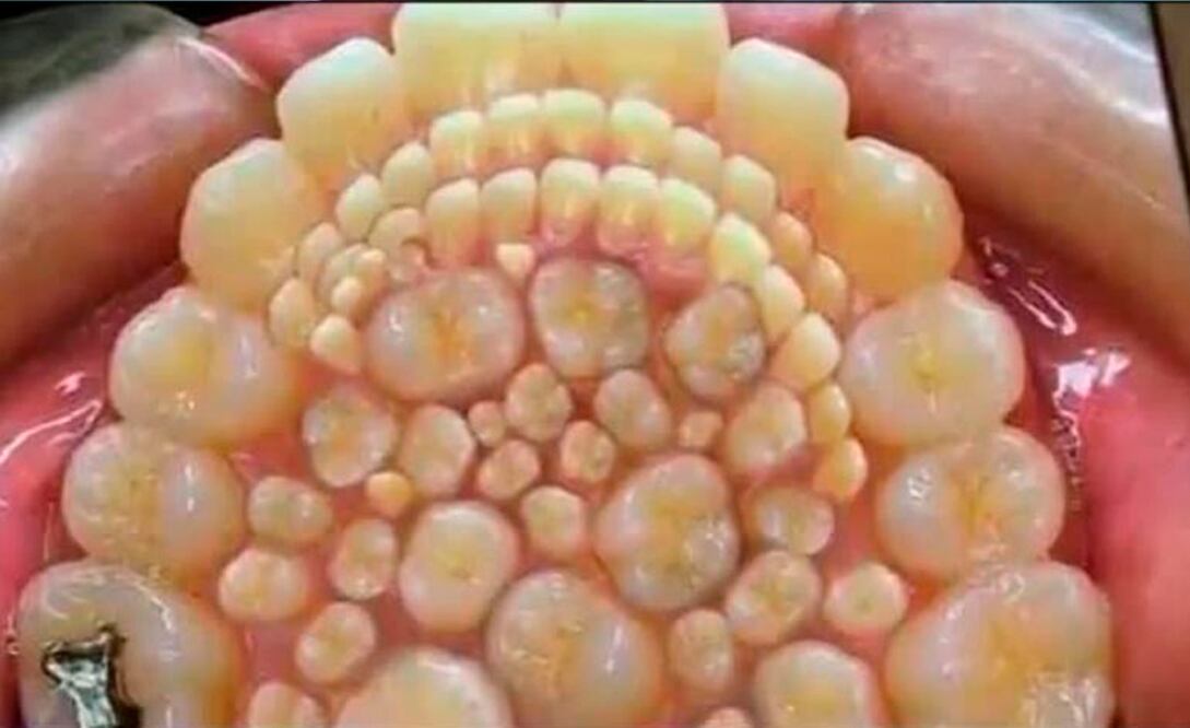 La enfermedad que llena la boca de dientes