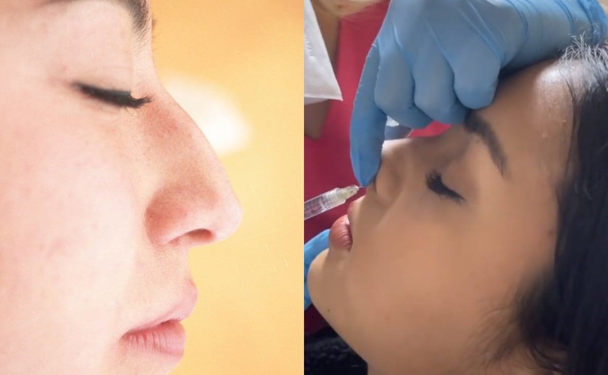 ¡Adiós rinoplastia! Así puedes cambiar el aspecto de tu nariz con ácido hialurónico