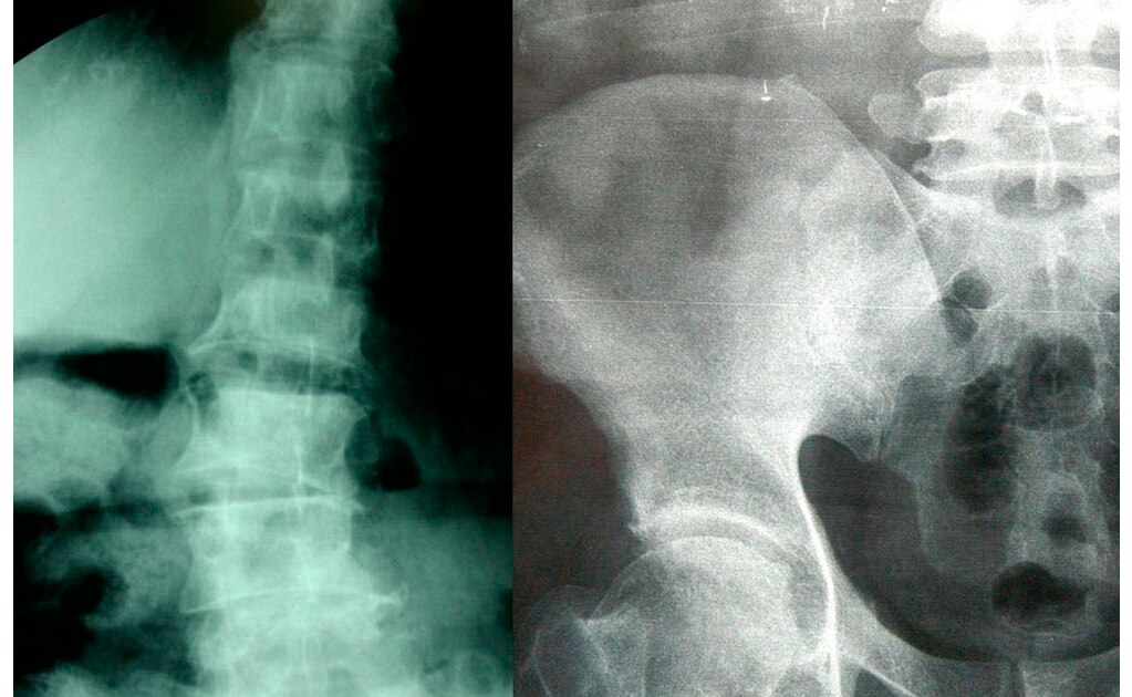 Llaman a población a prevenir efectos por osteoporosis