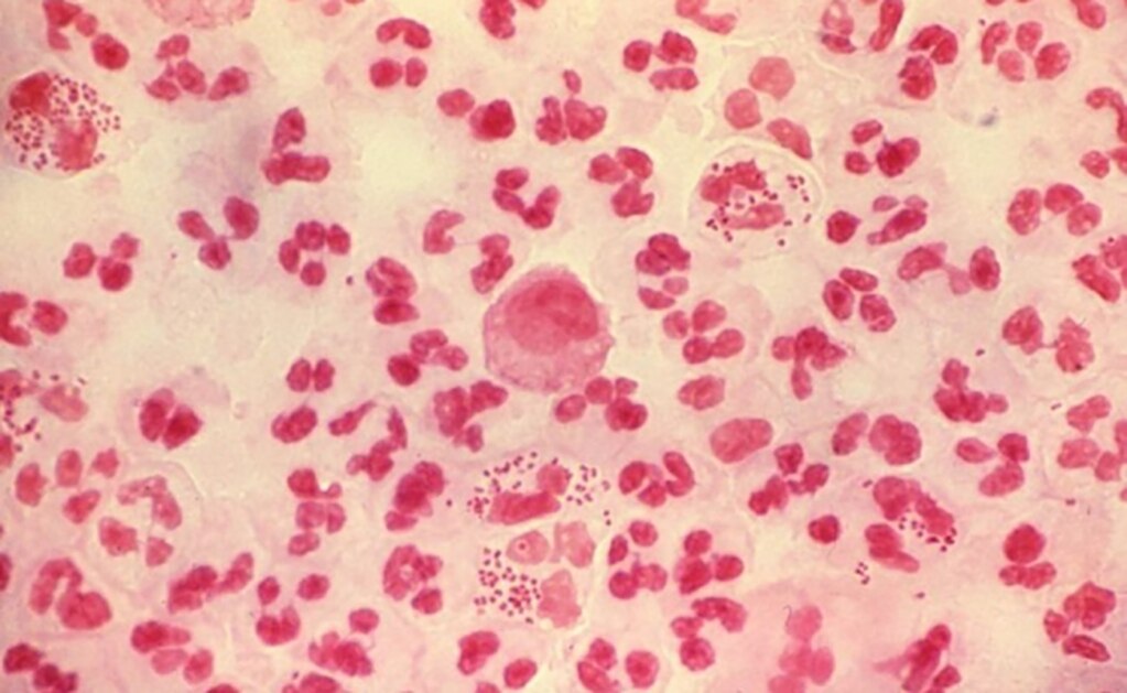 Investigan brote de gonorrea multirresistente