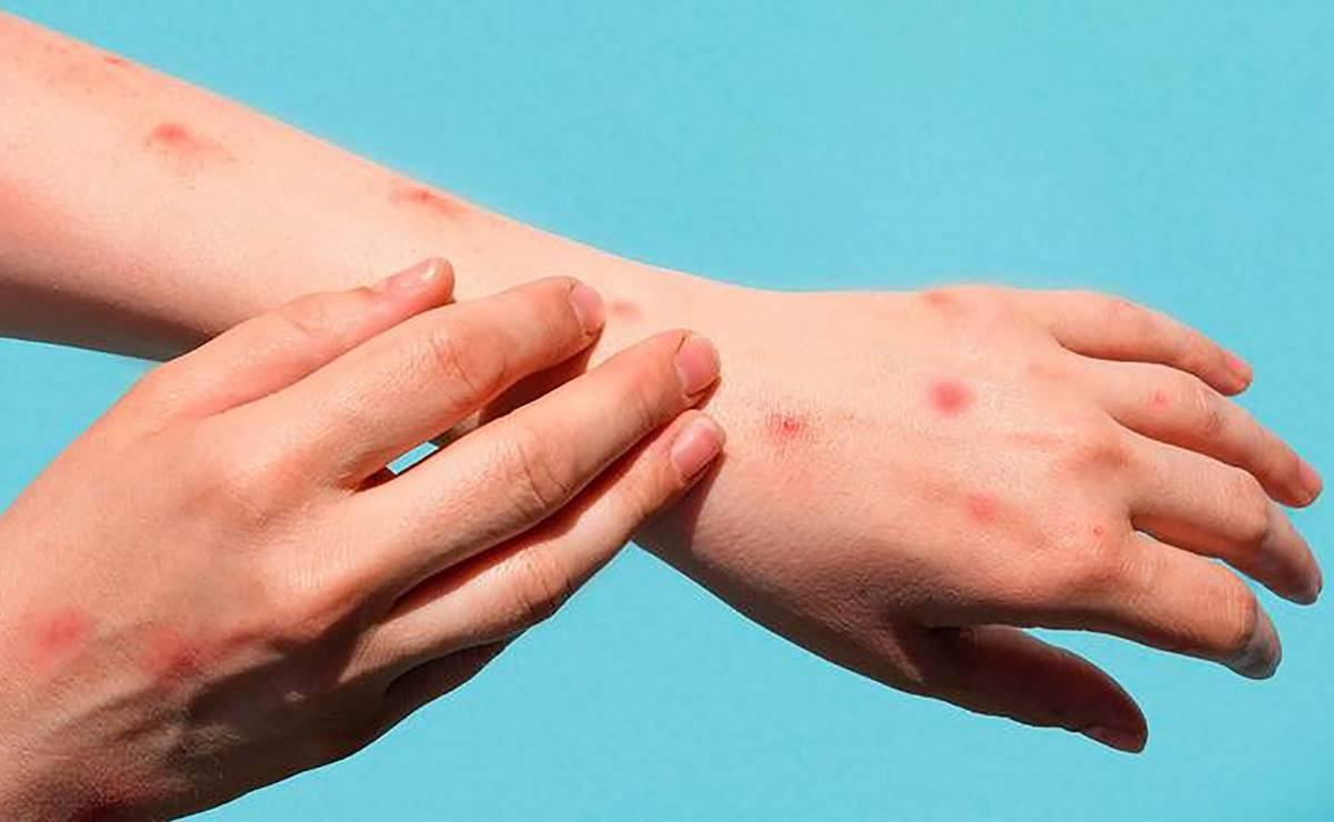 Activan protocolos en aeropuerto y centrales camioneras de SLP para contener viruela del mono