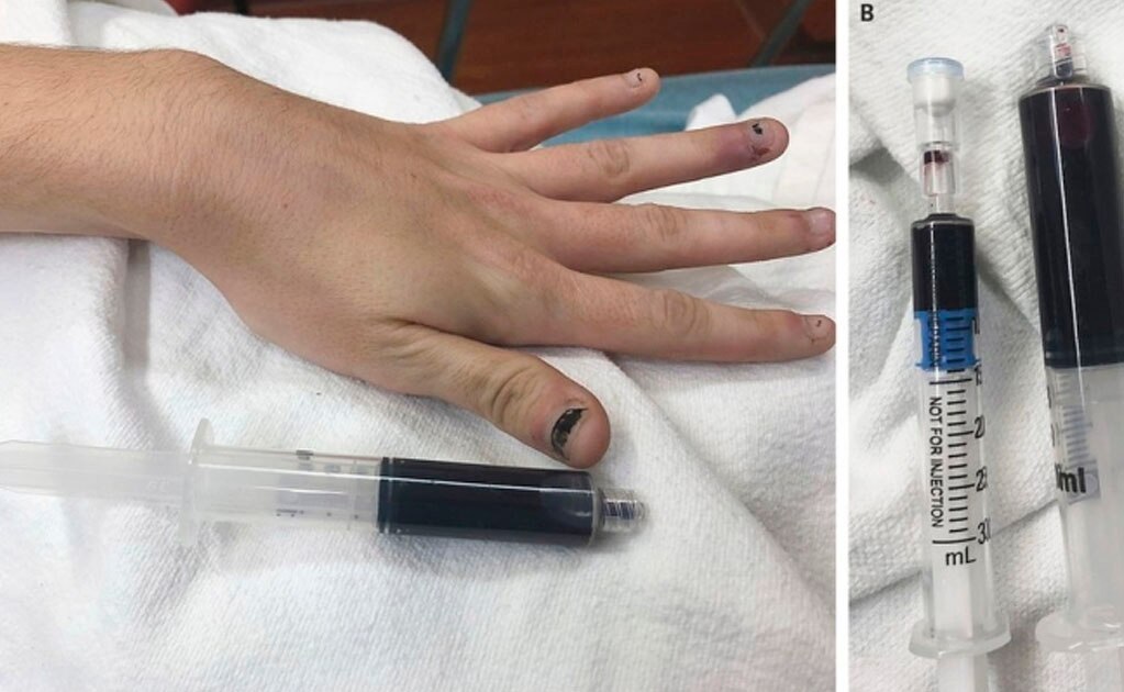 El extraño caso de una mujer a la que la sangre se le volvió azul