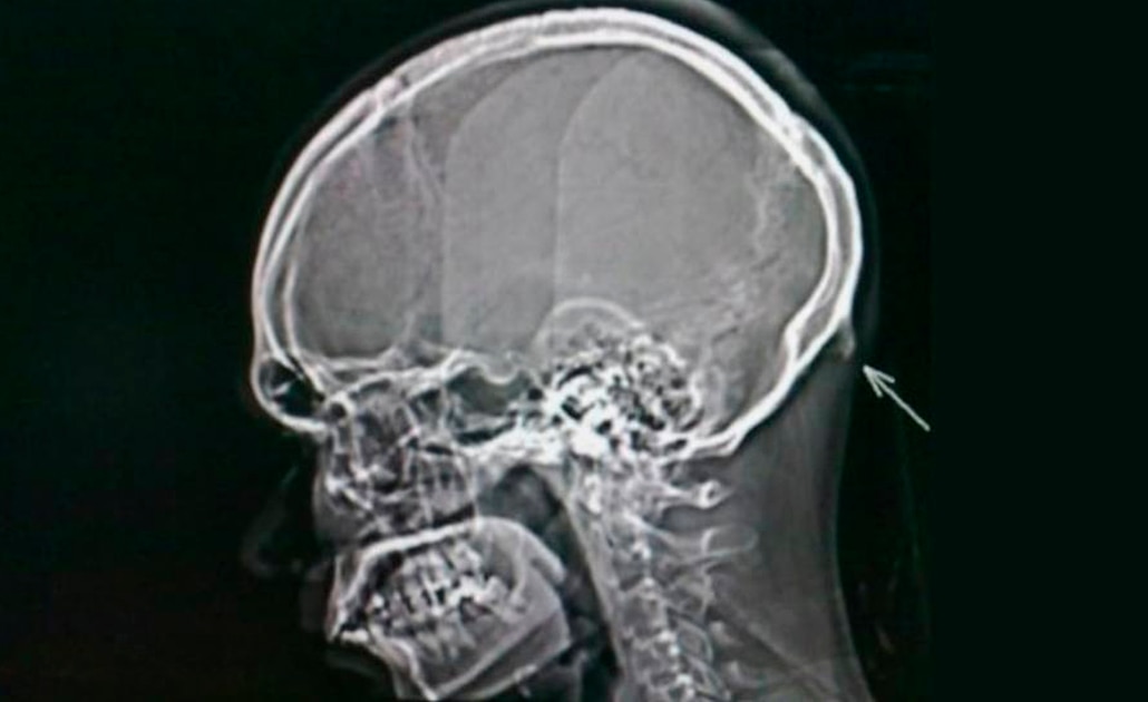 Uso de celulares provocaría crecimiento de “cuerno” en las personas