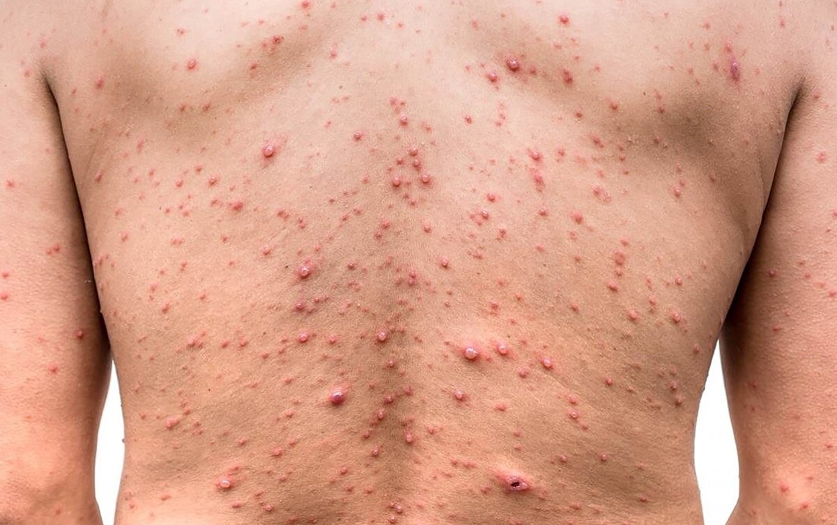 ¿Cuáles son los síntomas y cómo se da la transmisión de la viruela del mono?