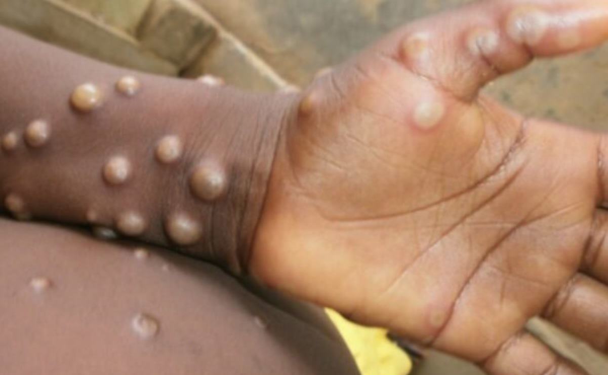 De San Luis Potosí solo se han analizado 9 muestras sospechosas de viruela símica: Salud estatal