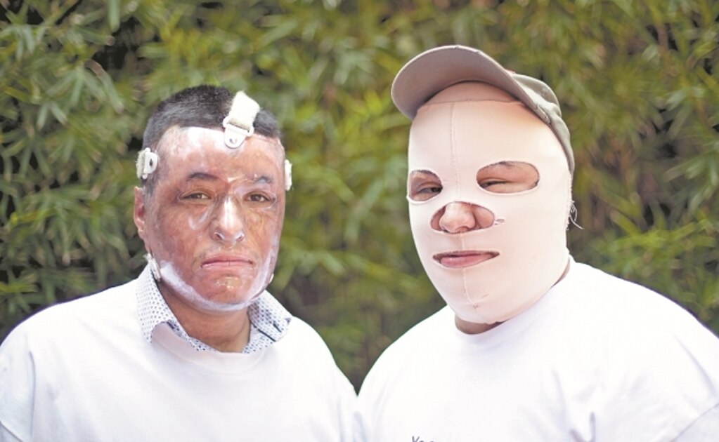 Tras el siniestro en Tlahuelilpan, Alan y Emmanuel fueron trasladados al hospital para niños quemados en Galveston, Texas; hoy empiezan a superar la depresión y a perseguir sus sueños. Foto: GERMÁN ESPINOSA. EL UNIVERSAL
