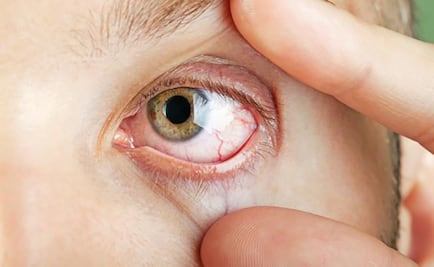 Emiten recomendaciones para prevenir síndrome de ojo seco