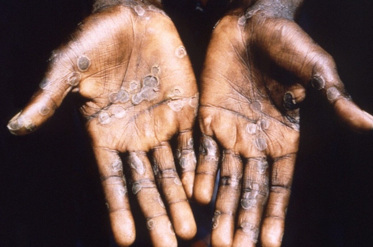 México registra el segundo caso de viruela del mono, confirma López-Gatell