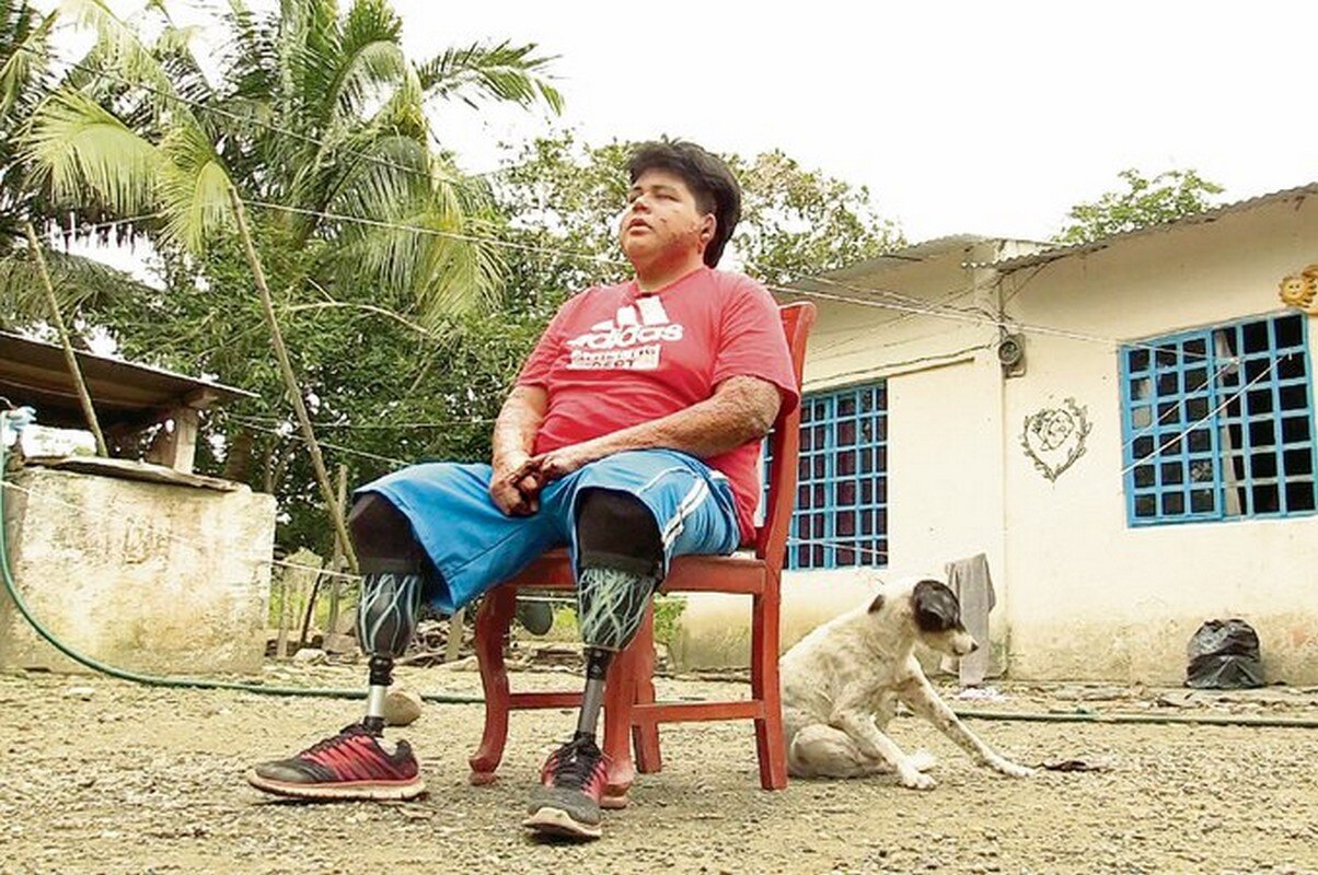  Perdió sus piernas por el huachicol; “no vale la pena arriesgarse”