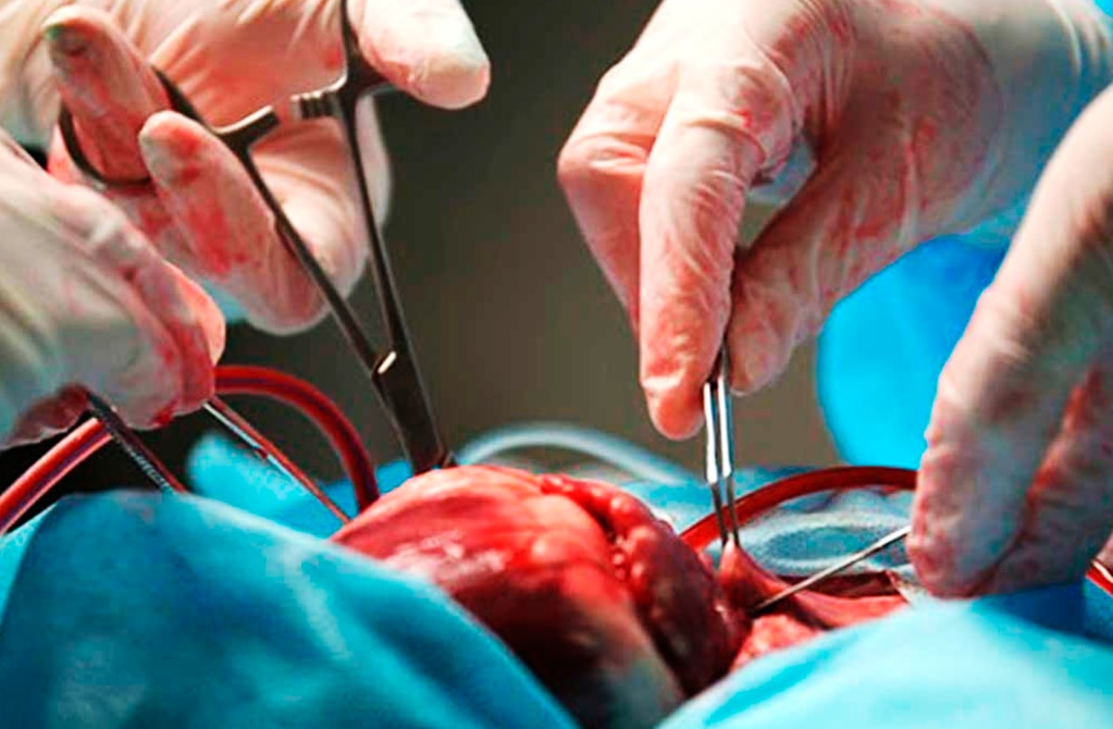 Baja donación de órganos en SLP