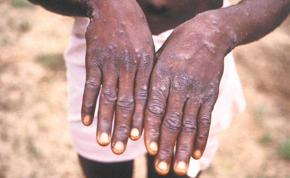 Aunque hasta el momento no se ha registrado ningún deceso por la viruela del mono, la enfermedad se ha extendido a 17 países. Foto: Archivo EL UNIVERSAL