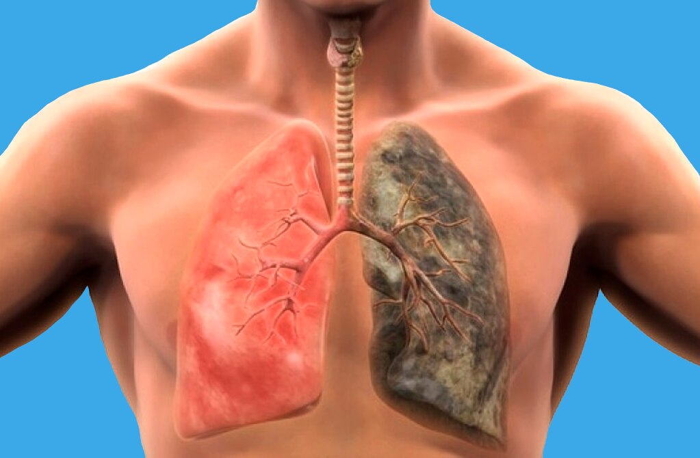 Cada año crece cáncer pulmonar en SLP