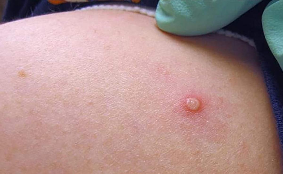 Detectan dos nuevos casos de viruela símica en San Luis Potosí; suman 9