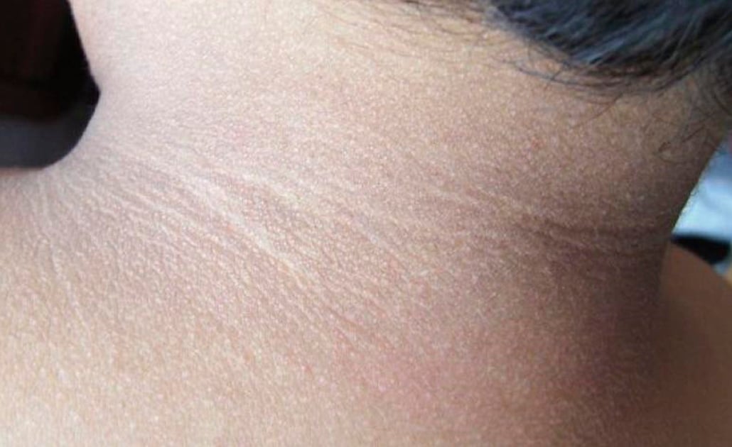 Oscurecimiento de cuello es signo de prediabetes