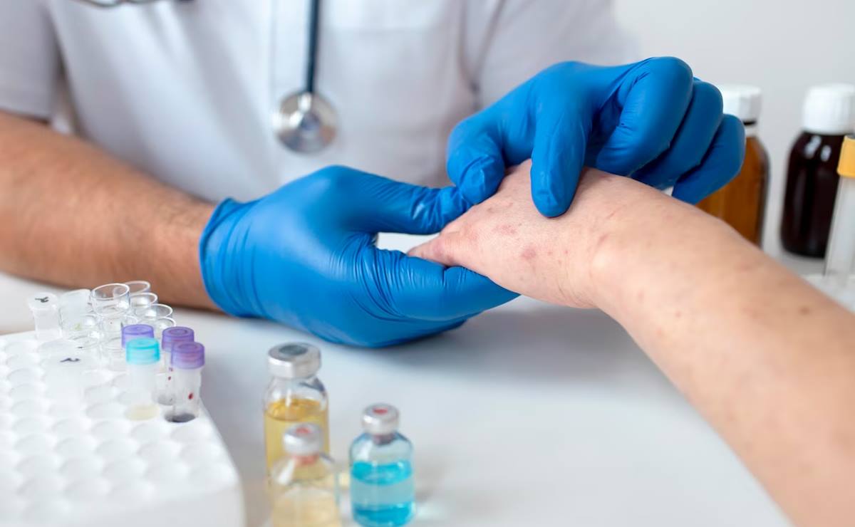 ¿Qué es la lepra y cómo afecta a las personas en SLP?