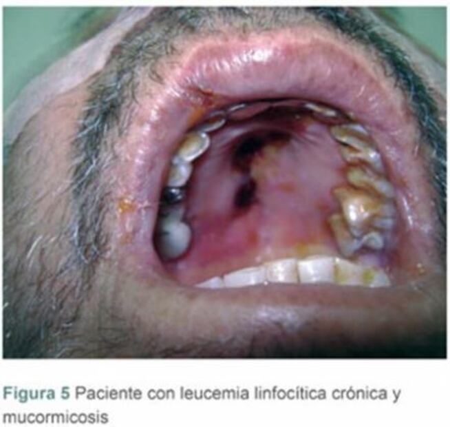 Lo que sabemos del hongo negro, la enfermedad que cobró la vida de un mexicano