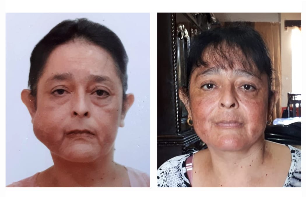 Doña Rosa ha vuelto a sonreír luego de extirparle un tumor de la mejilla