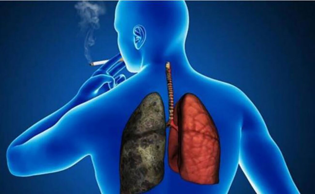 Con la estrategia del Caballo de Troya, luchan contra cáncer pulmonar