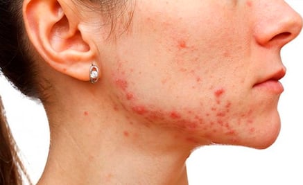 ¿Cómo saber si tienes quistes en los ovarios?